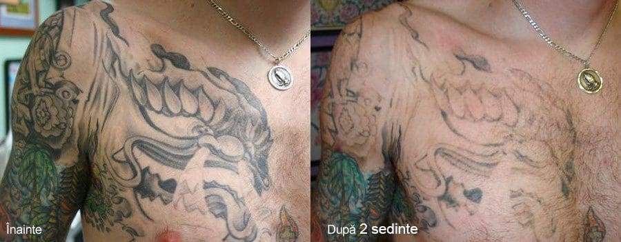 eliminare tatuaj laser