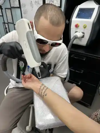 image00003 eliminare tatuaj laser
