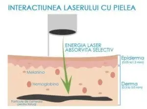 interactiunea laserului cu pielea