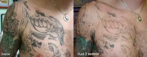 eliminare tatuaj laser