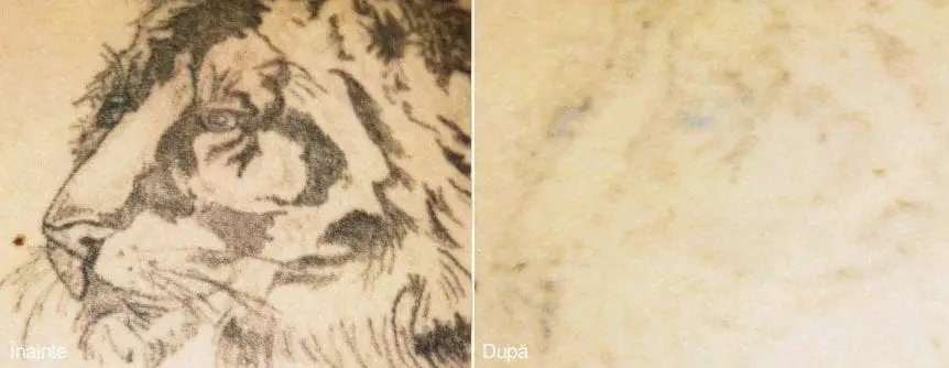 Stergerea tatuajului laser