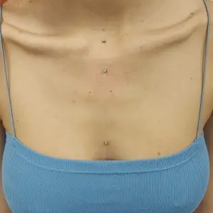 Piercing Dermal